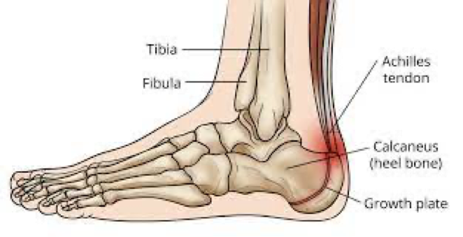 Sever's disease anatomy