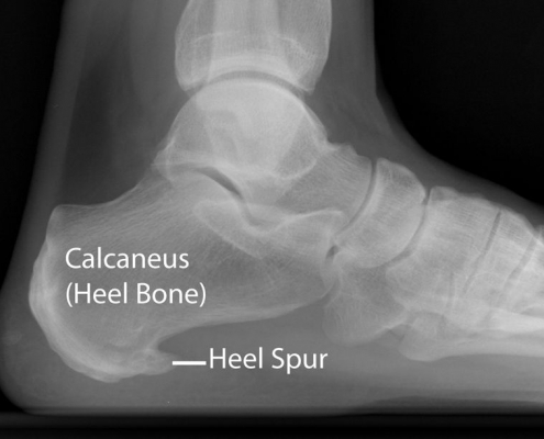 Foot Xray Heel Spur