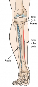 Shin Splints Robina Physio