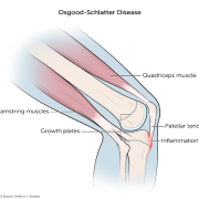 Osgood-Schlatters Robina Physio