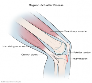 Osgood-Schlatter Disease Robina Physio