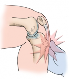 Osgood-Schlatter Disease Physio Robina