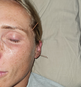Dry Needling of TMJ