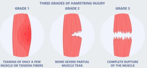 Hamstring Strains Grades