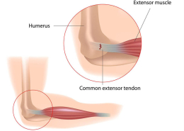 Tennis Elbow Tendon Pain