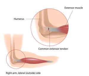 Tennis Elbow Tendon Pain