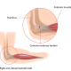 Tennis Elbow Tendon Pain