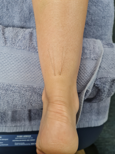 Achilles Pain Dry Needling