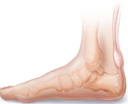 Achilles pain diagram Achilles myths