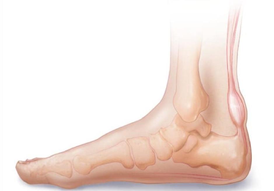I have achilles discount tendonitis