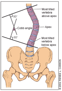 Scoliosis Cobb Angle