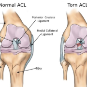 ACL Physio ACL Anatomy