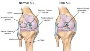 ACL Physio ACL Anatomy