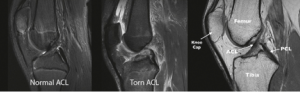 ACL Tear MRI for Cross Bracing