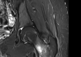 MRI showing femoral stress fracture