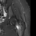 MRI showing femoral stress fracture