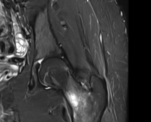 MRI showing femoral stress fracture