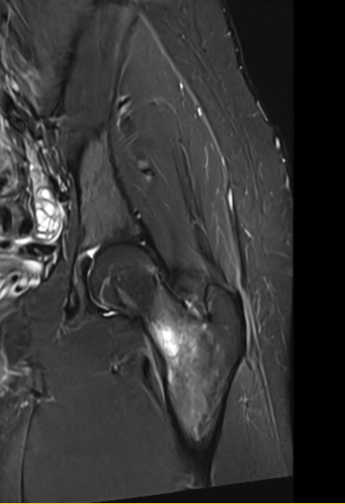 MRI showing femoral stress fracture